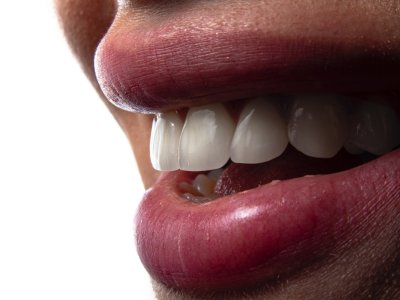 ¿Por qué elegir implantes dentales? Ventajas, proceso y cuidados para recuperar tu sonrisa