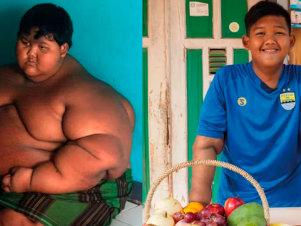 Indonesia: El cambio físico del niño que fue catalogado como el más gordo del mundo